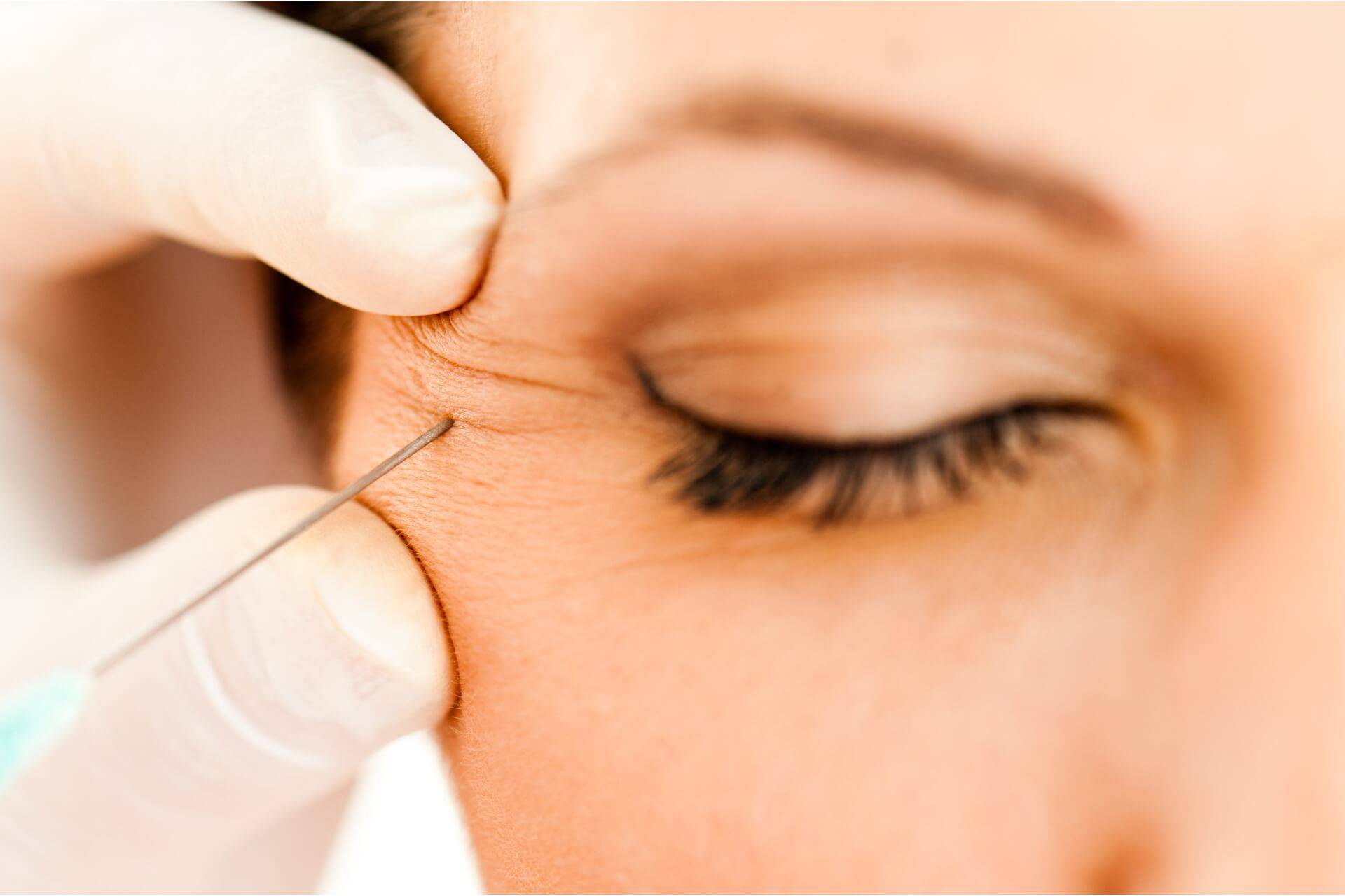 botox antiage per trattare le rughe