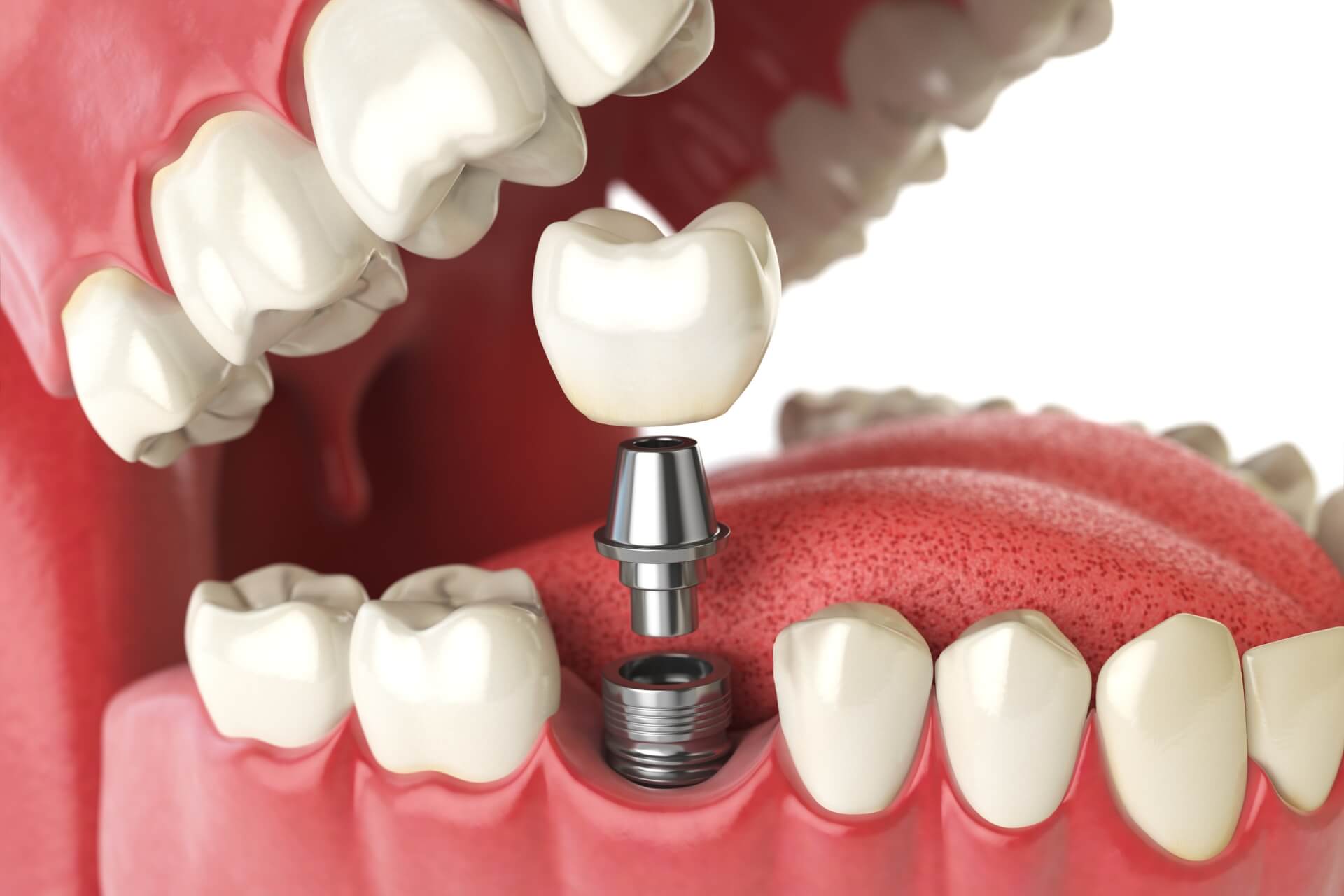 impianti dentali per sostituire denti rotti o lesionati