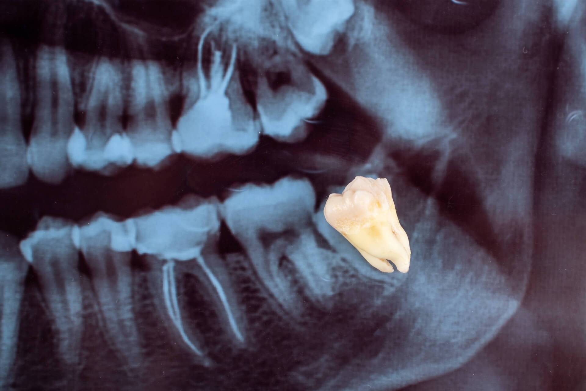 denti del giudizio quando crescono e quando estrarli