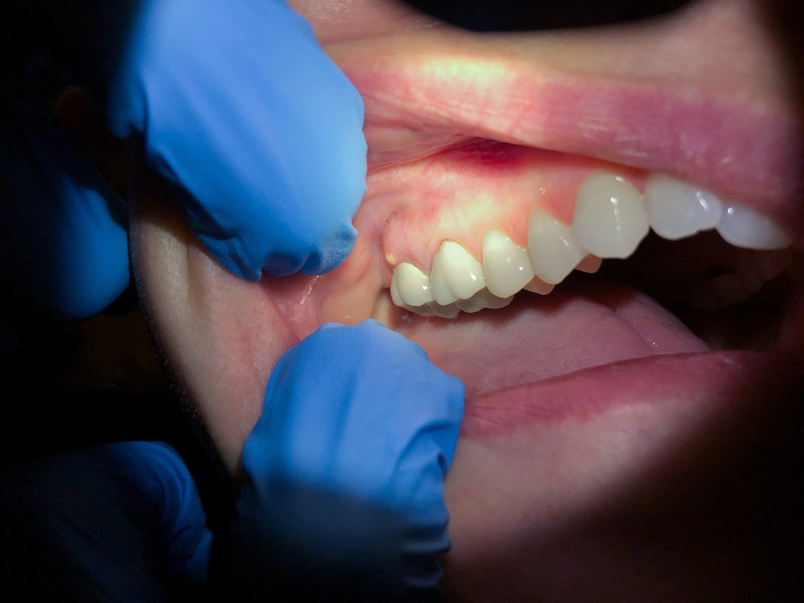 ascesso-dentale-denti-gonfiore-odontoiatria.jpeg