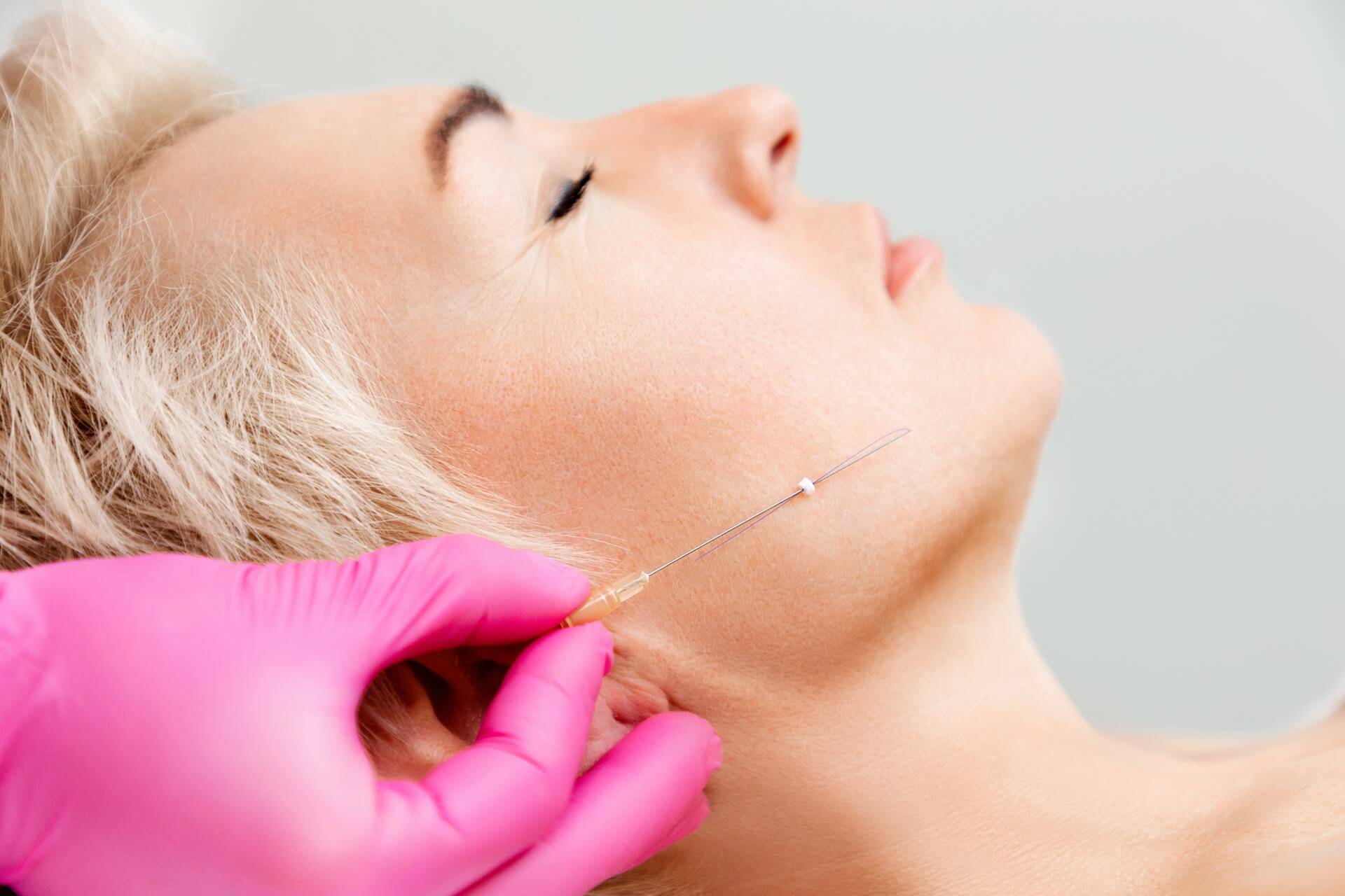 lifting-viso-fili-biostimolanti-clinica-marchetti-medicina-estetica.jpg