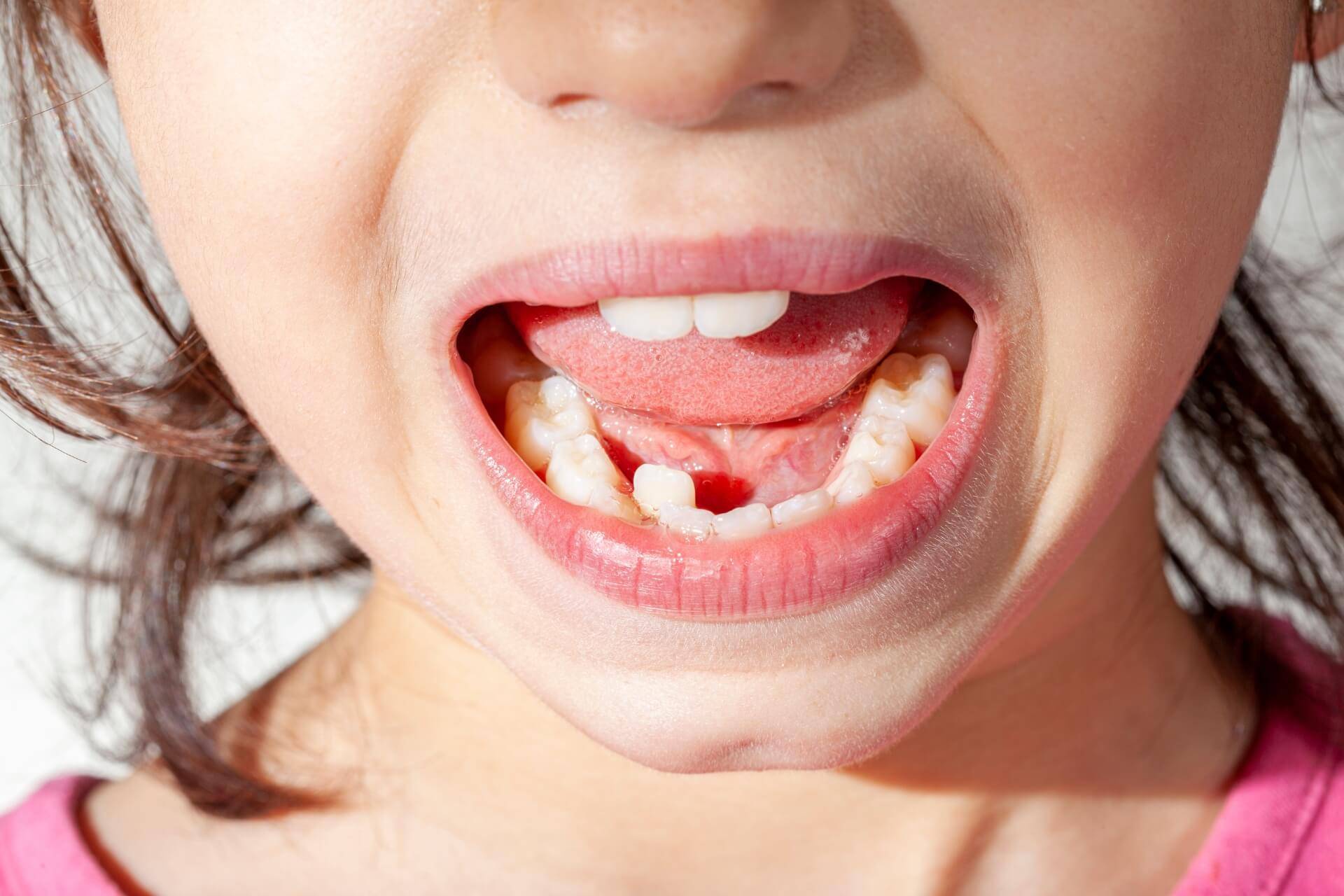 disallineamento dentale e dentista per bambini