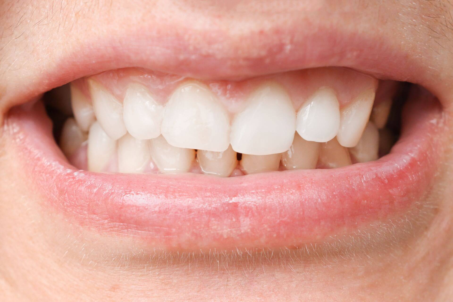 problemi derivanti dalle malocclusioni dentali