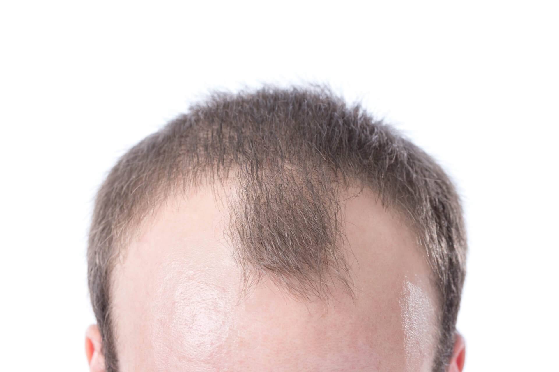 alopecia-precoce-calvizie-giovanile-perdita-capelli.jpg