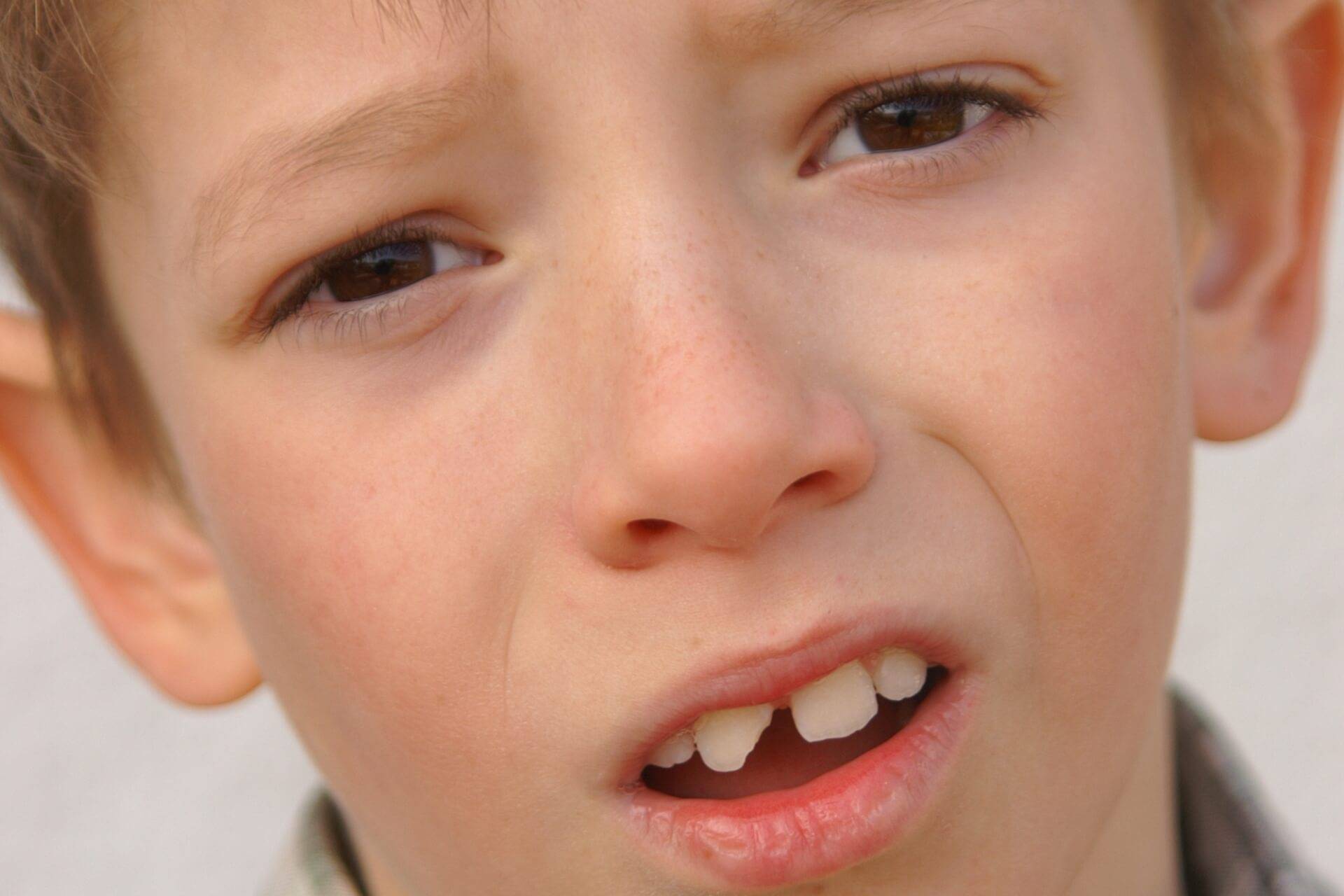 incidente con dente da latte rotto in un bambino