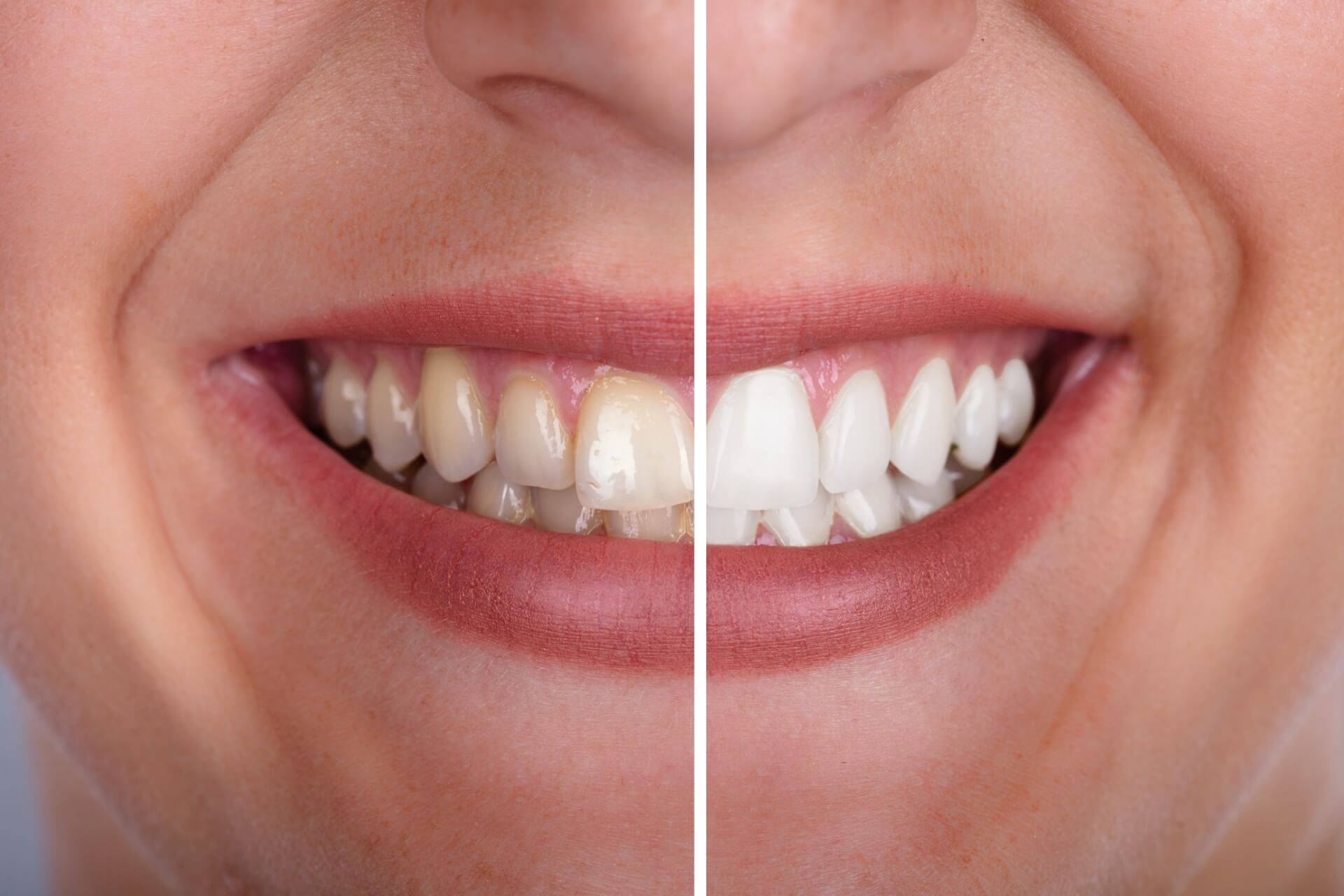 sbiancamento-denti-domiciliare.jpg