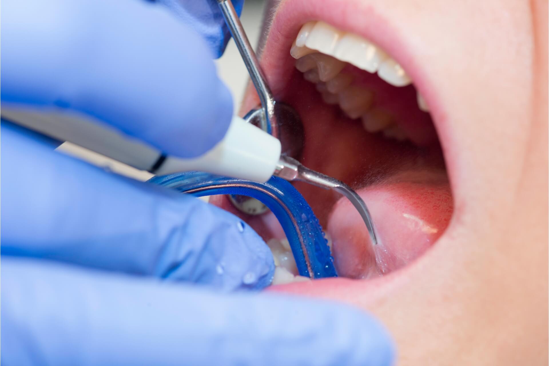 trattamento di igiene orale professionale eseguito nello studio odontoiatrico da un'igienista dentale
