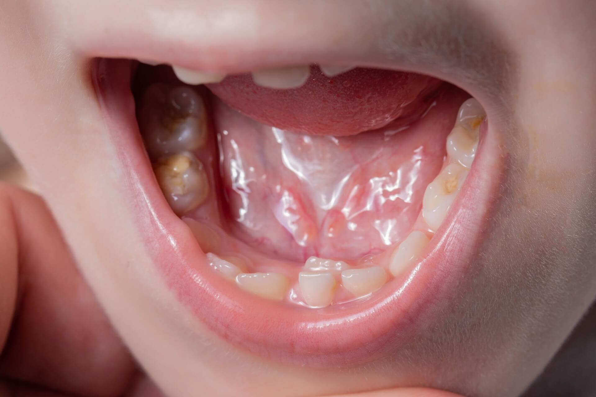 denti da squalo nei bambini