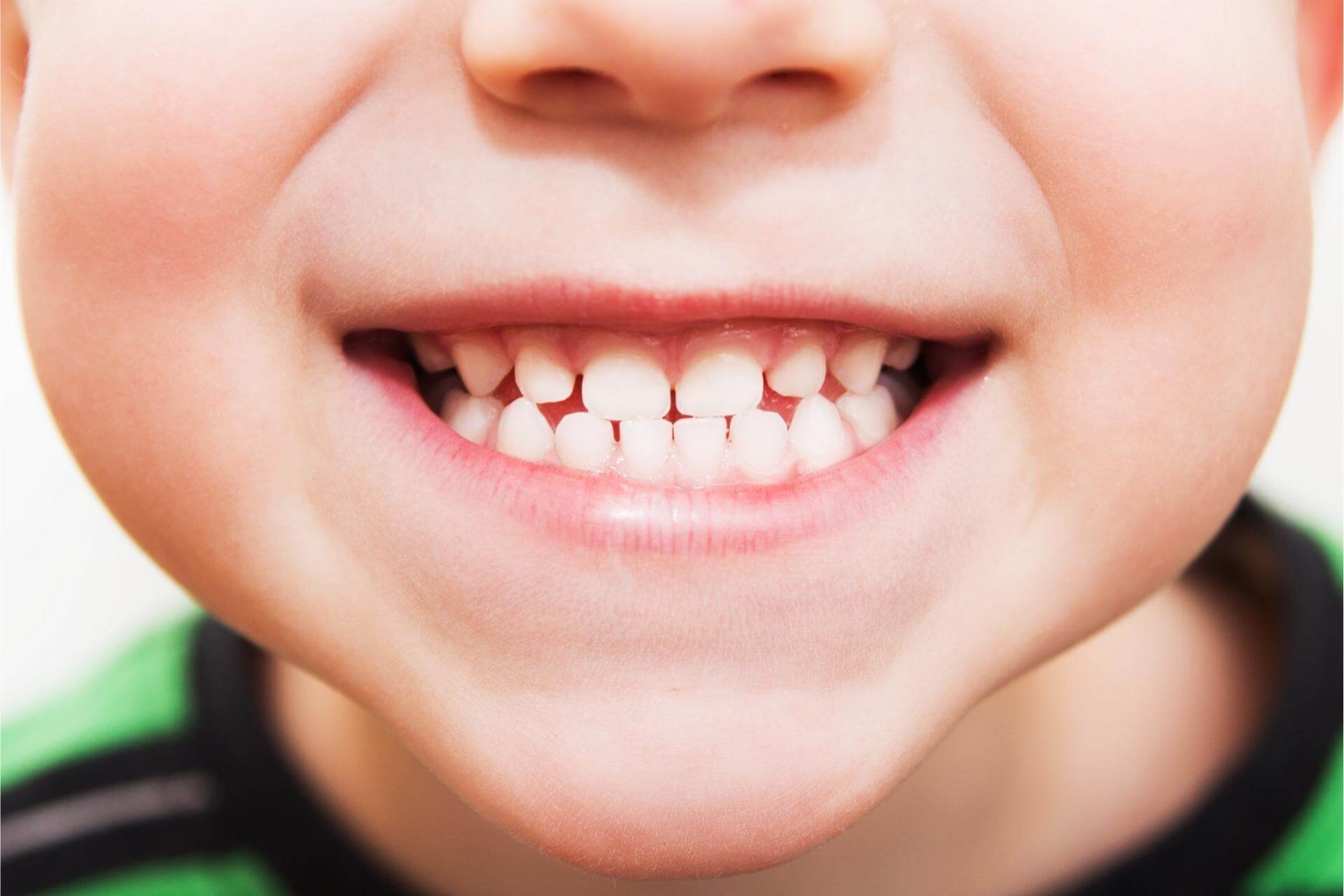 sigillatura-denti-bambini-dentista-carie-prevenzione.jpg