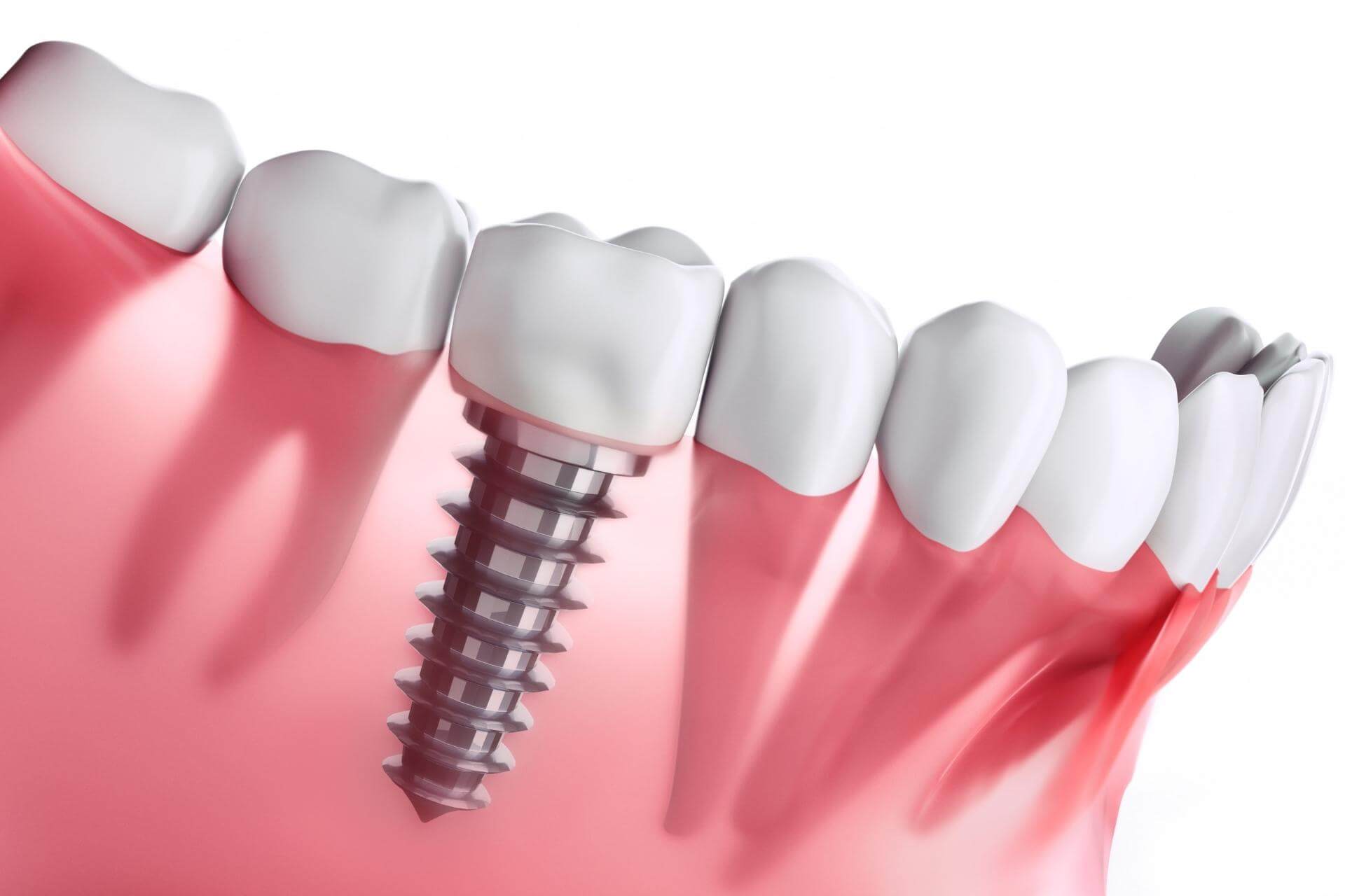 implantologia dentale di nuova generazione