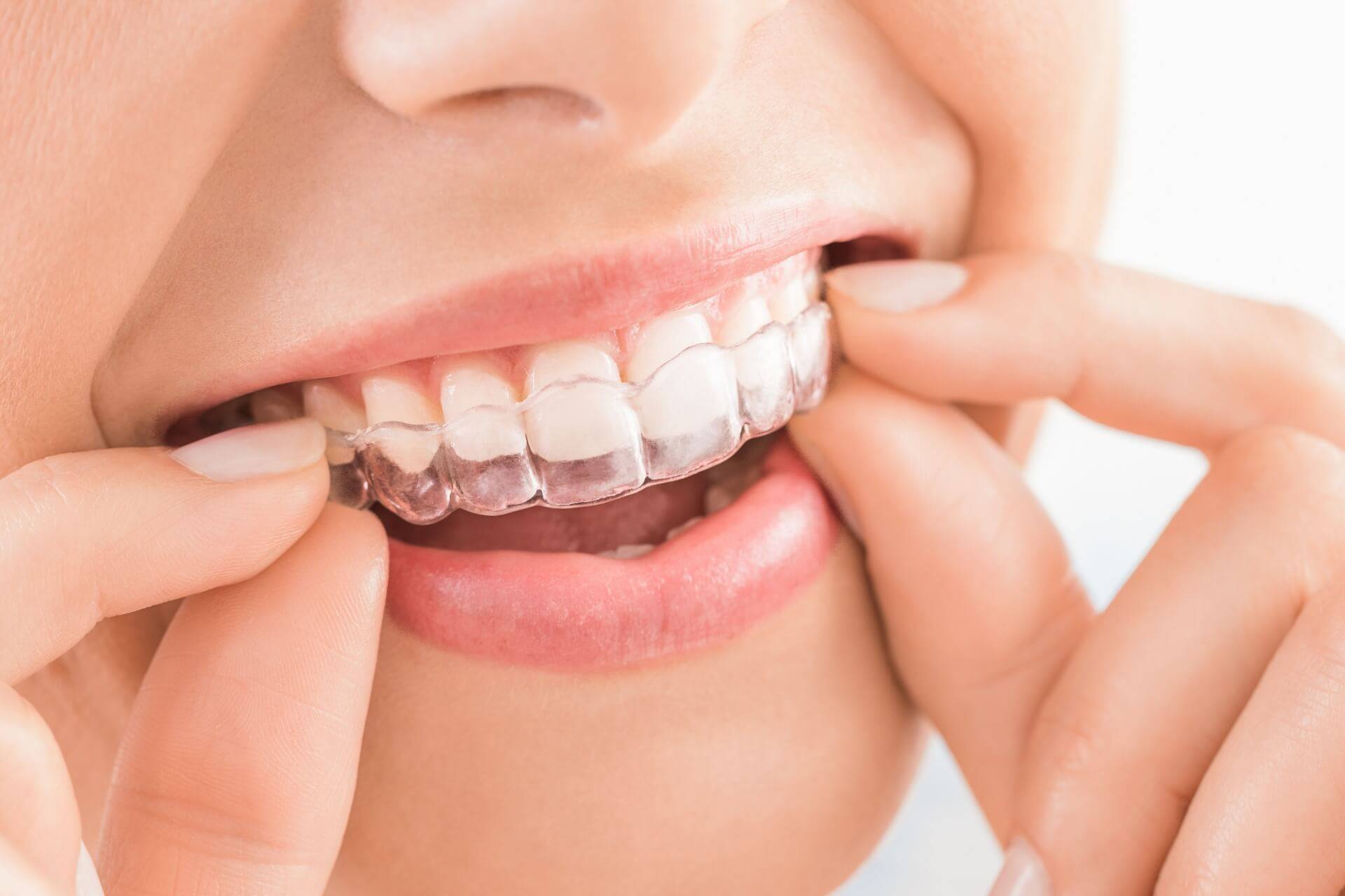 mascherine trasparenti per allineare i denti