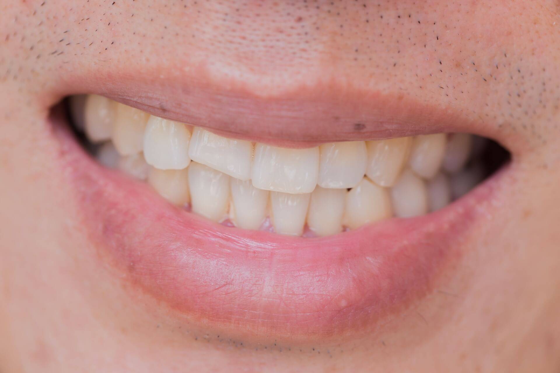 ricostruzione dentale diretta per denti danneggiati o cariati