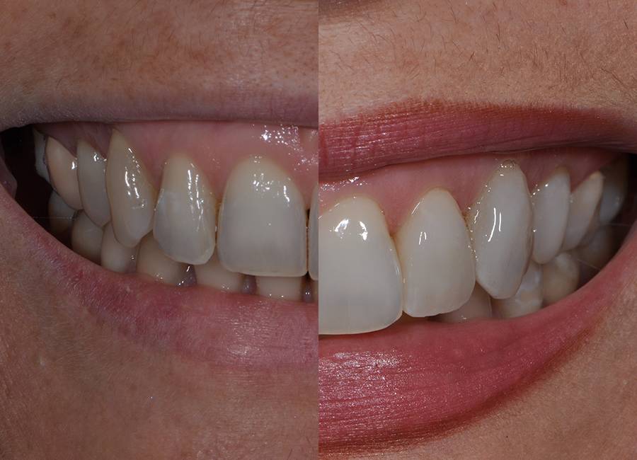 Rivestimento con faccette dentali a Morbegno