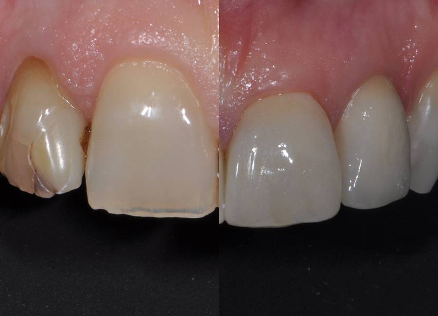 Ricostruzione cosmetica di denti danneggiati a Morbegno