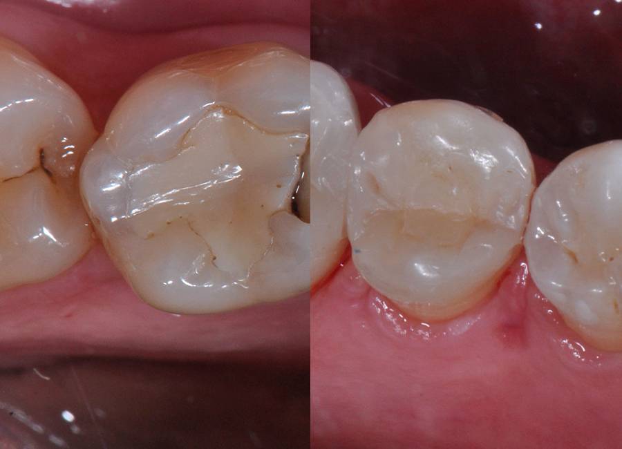 I risultati degli interventi della Clinica Marchetti su corone e intarsi dentali