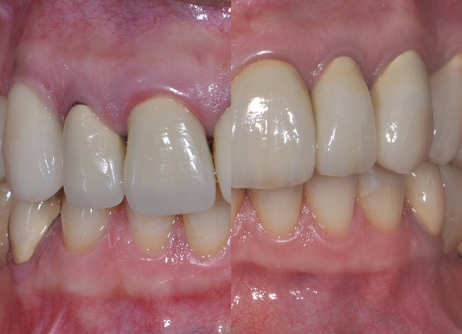 Odontoiatria restaurativa indiretta contro gli inestetismi dei denti