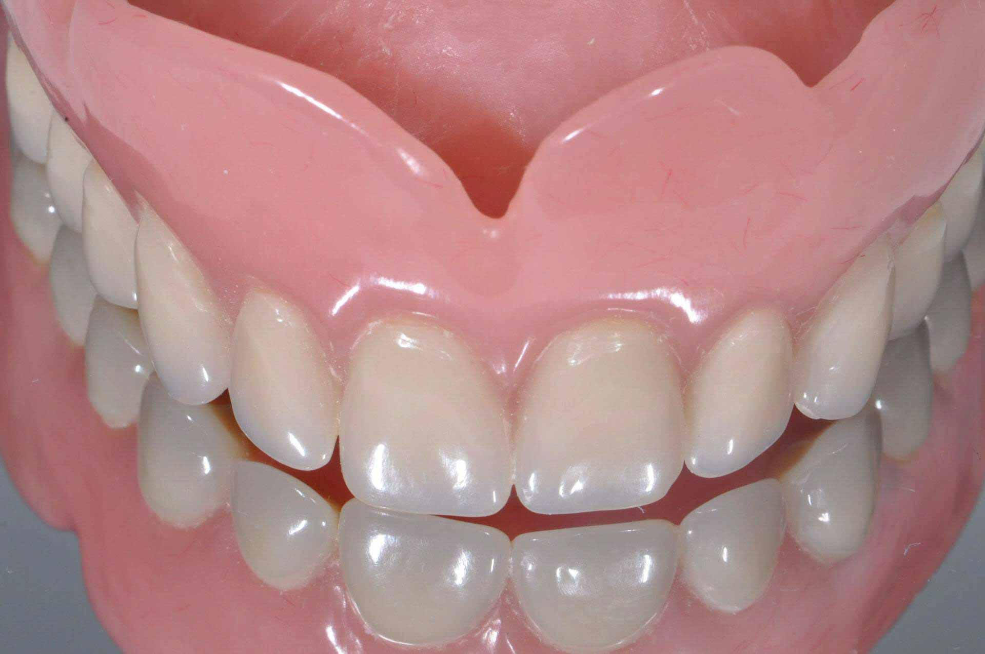 Protesi dentali in resina stabili e sicure