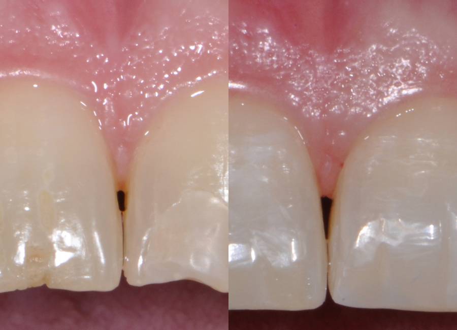 Ricostruzione di denti incisivi a Morbegno