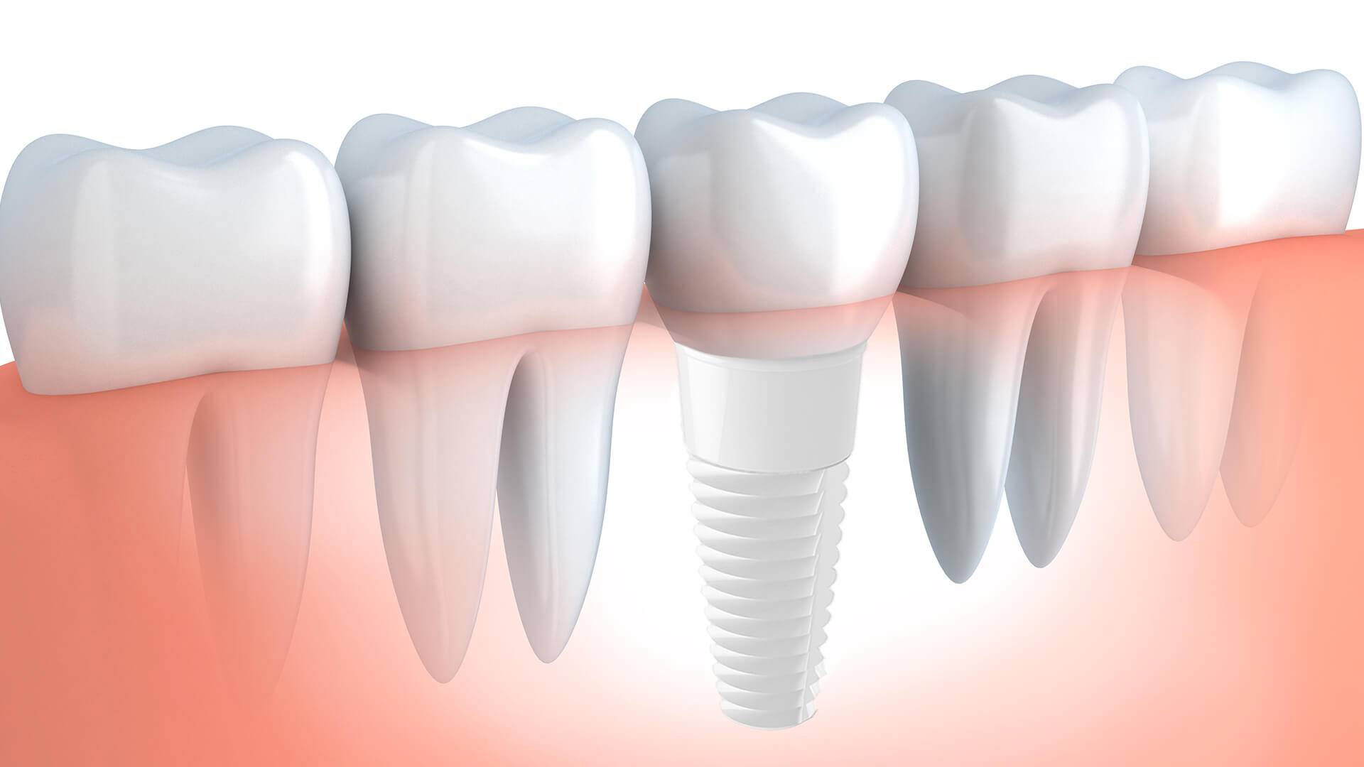 impianti in ossido di zirconio