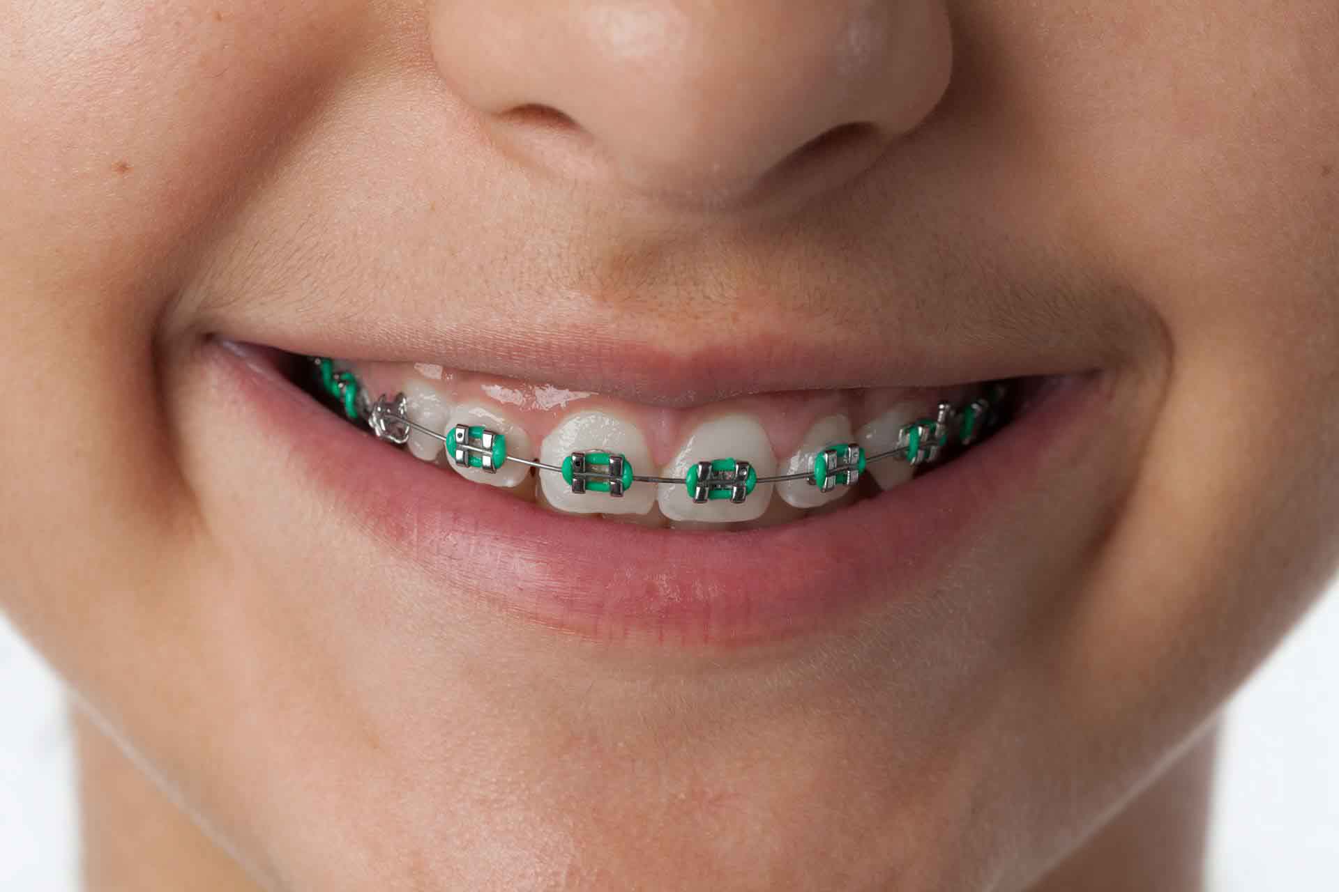 Riallineare i denti con l'apparecchio ortodontico