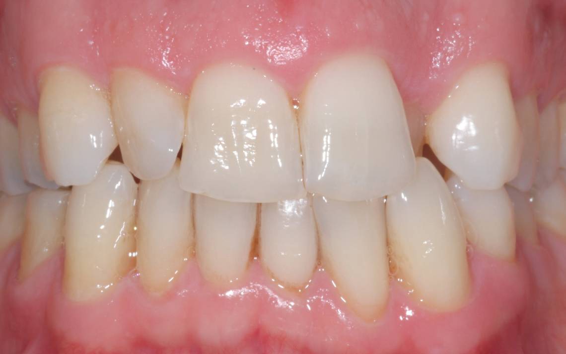 Ortodonzia a Morbegno: riallineamento dei denti