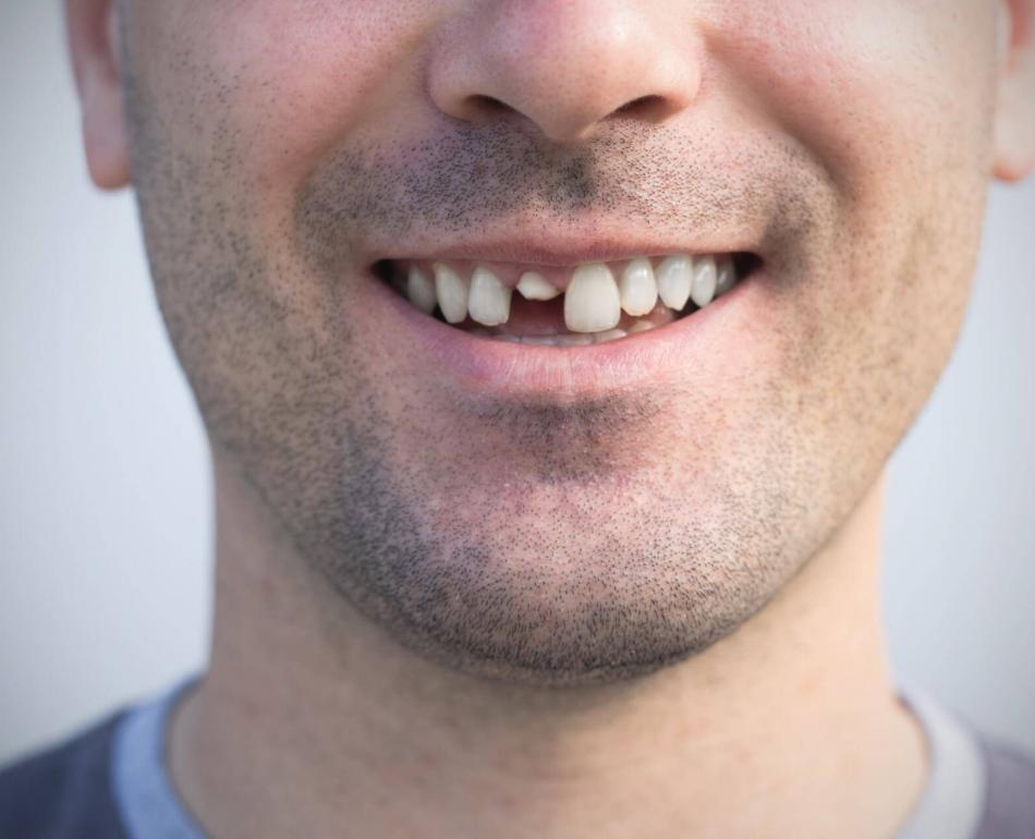 impianti dentali per sostituire denti rotti o lesionati