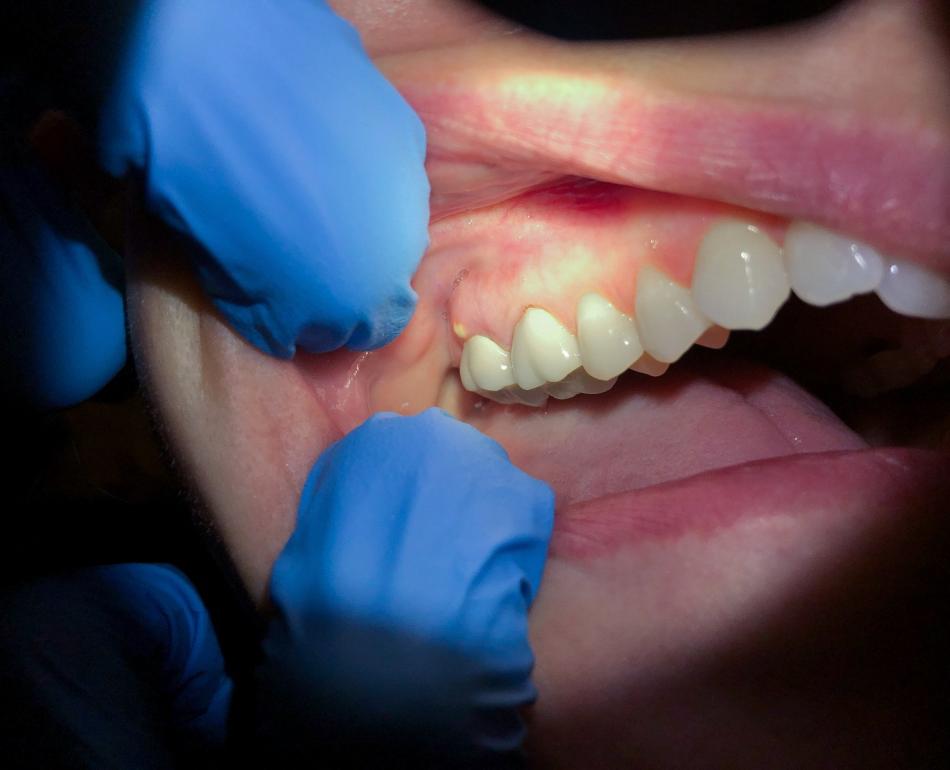 ascesso dentale in bocca