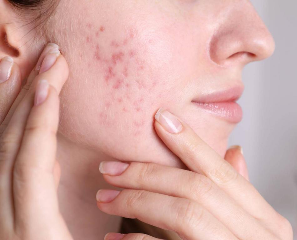 segni dell'acne sulla pelle del viso negli adulti