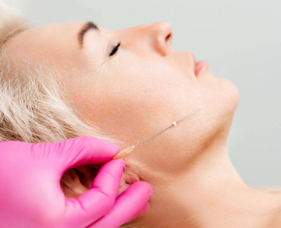 lifting con fili biostimolanti per ringiovanimento pelle e viso