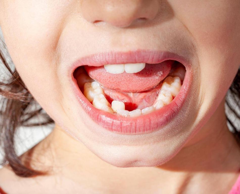 disallineamento dentale e dentista per bambini