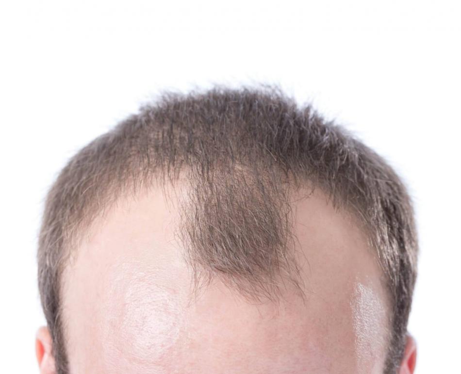 calvizie precoce o alopecia giovanile