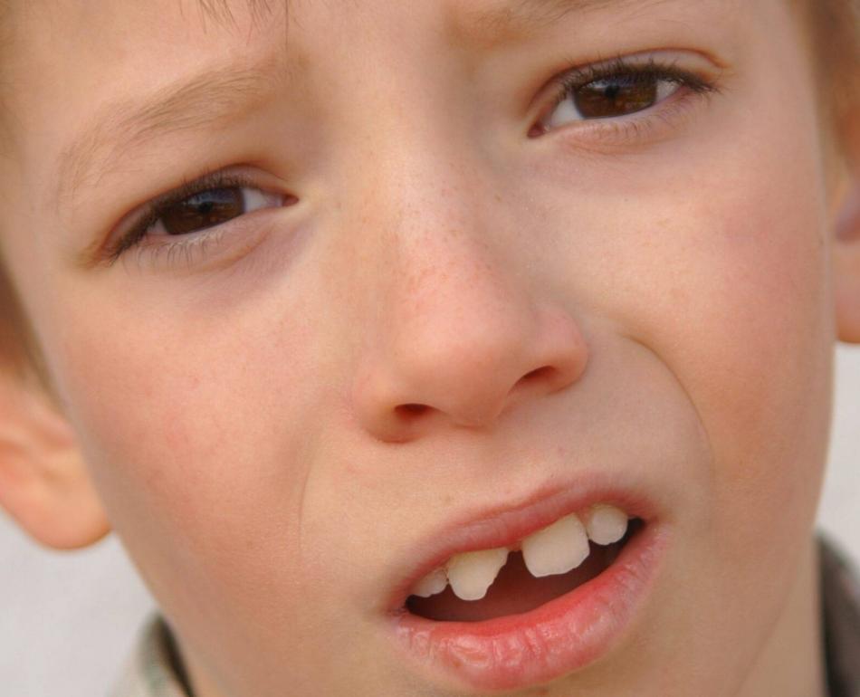 incidente con dente da latte rotto in un bambino