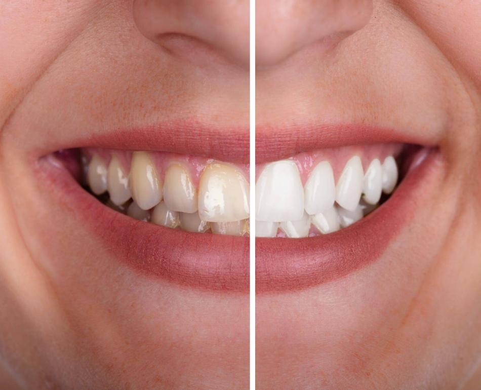risultati ottenuti con lo sbiancamento denti domiciliare con mascherina