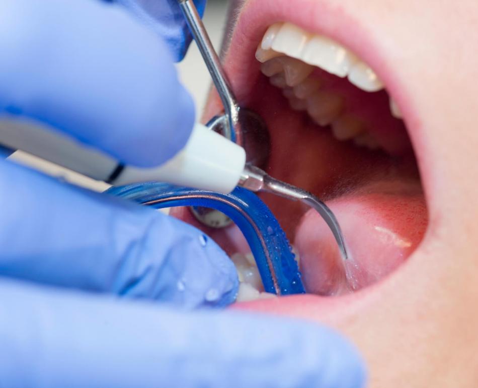 trattamento di igiene orale professionale eseguito nello studio odontoiatrico da un'igienista dentale