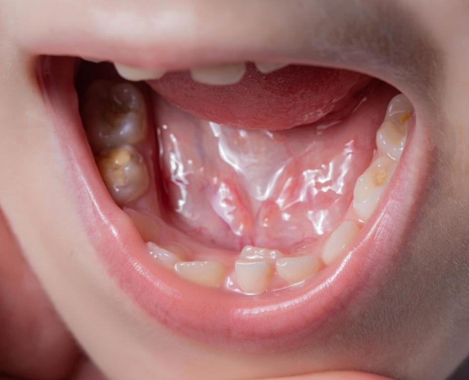 denti da squalo nei bambini