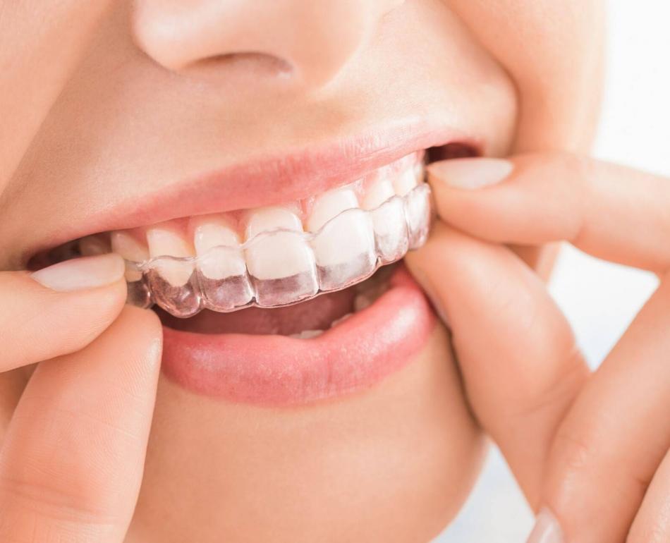 mascherine trasparenti per allineare i denti