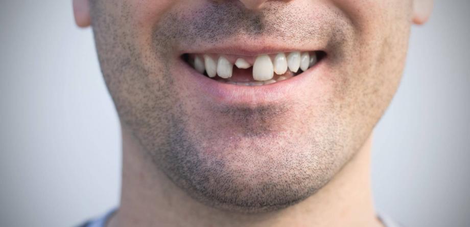 impianti dentali per sostituire denti rotti o lesionati