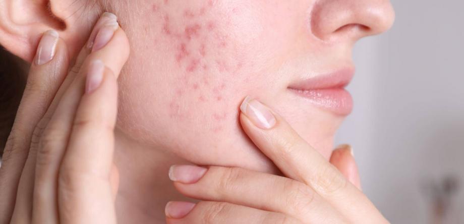 segni dell'acne sulla pelle del viso negli adulti