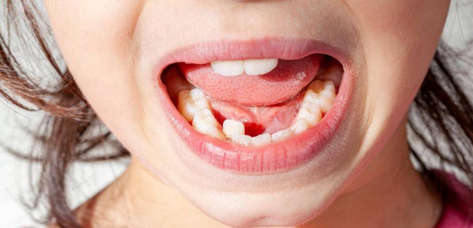 disallineamento dentale e dentista per bambini