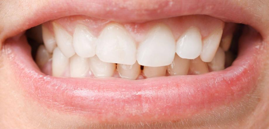 problemi derivanti dalle malocclusioni dentali