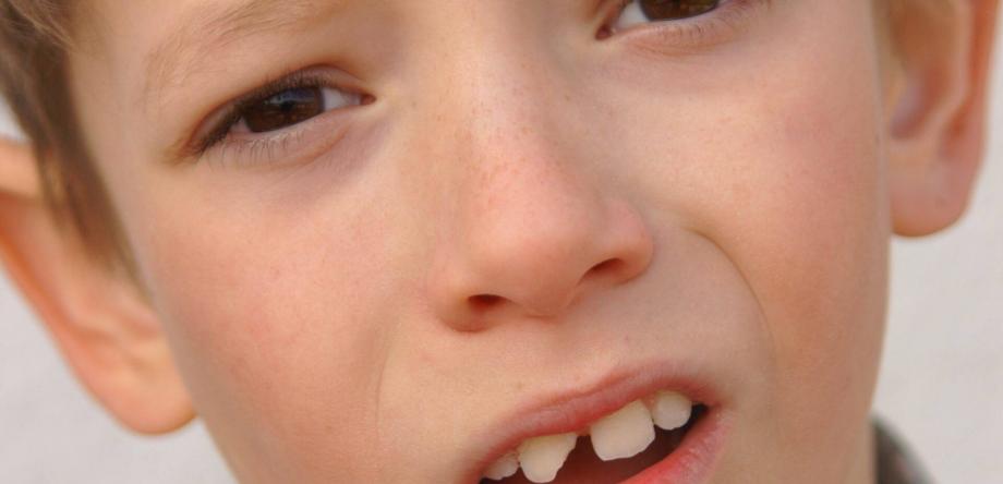 incidente con dente da latte rotto in un bambino