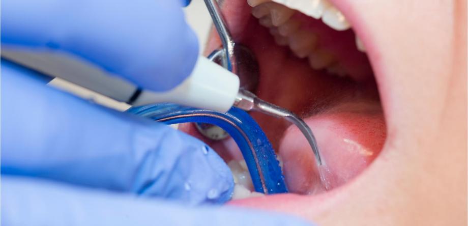trattamento di igiene orale professionale eseguito nello studio odontoiatrico da un'igienista dentale