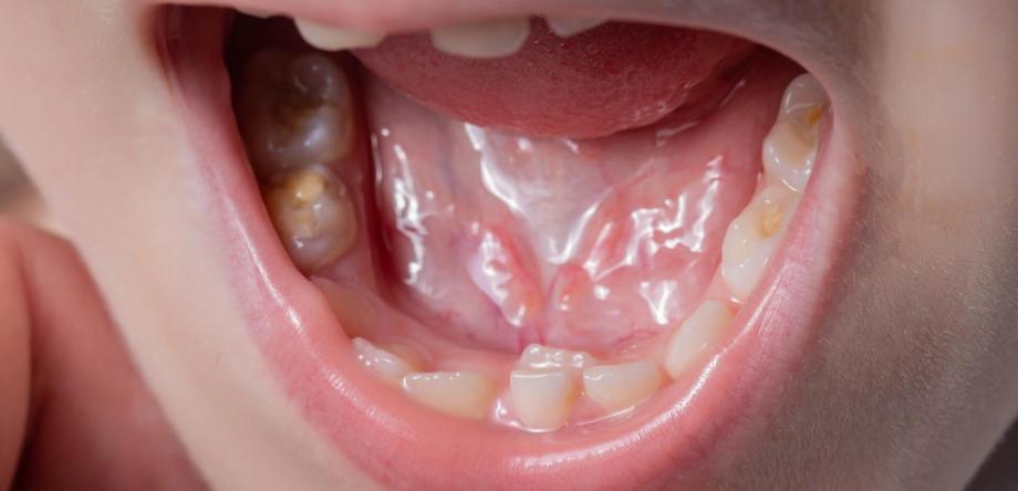 denti da squalo nei bambini