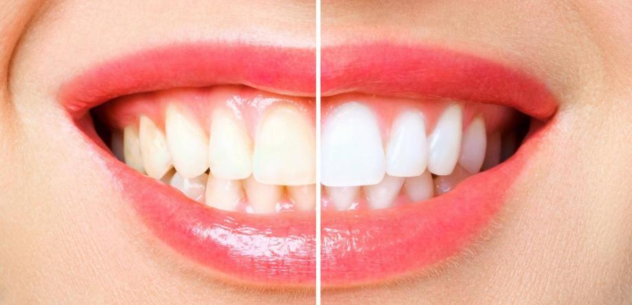 come sbiancare i denti: prima e dopo