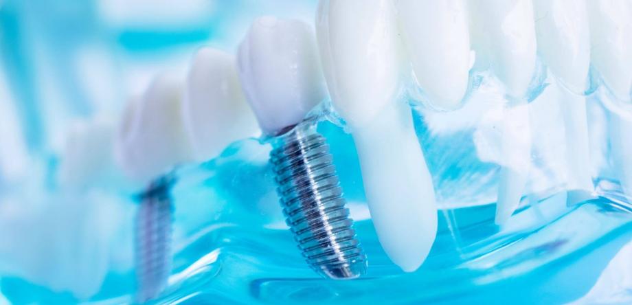 implantologia dentale: impianti carico immediato
