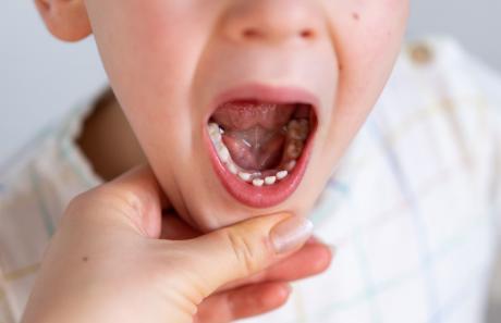 carie bambini: prevenzione, cura, igiene orale, dentista