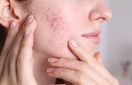 segni dell'acne sulla pelle del viso negli adulti