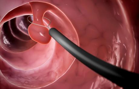 polipi nel naso: come si curano