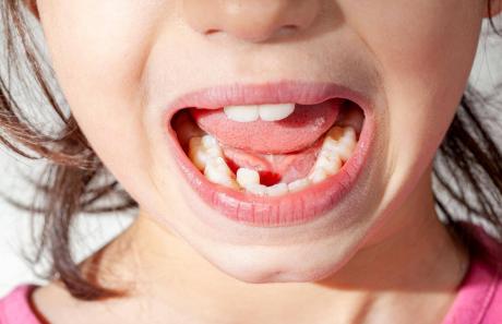 disallineamento dentale e dentista per bambini