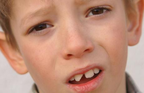 incidente con dente da latte rotto in un bambino